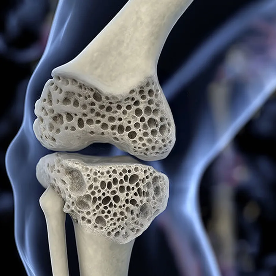 Остеопороз